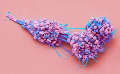 Kanserle mücadelede üç önemli gelişme