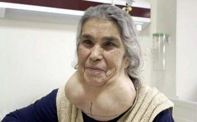 Korkudan doktora gitmeyince boyun şişliği 2 kiloya ulaştı