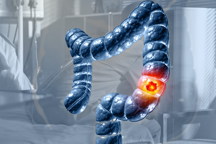 Uzmanlar şokta: En ölümcülü artık ‘meme kanseri’ değil