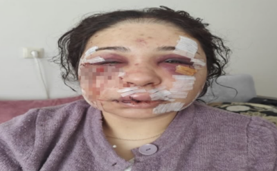 Yüzünde 60 dikiş olan kadına ceza!